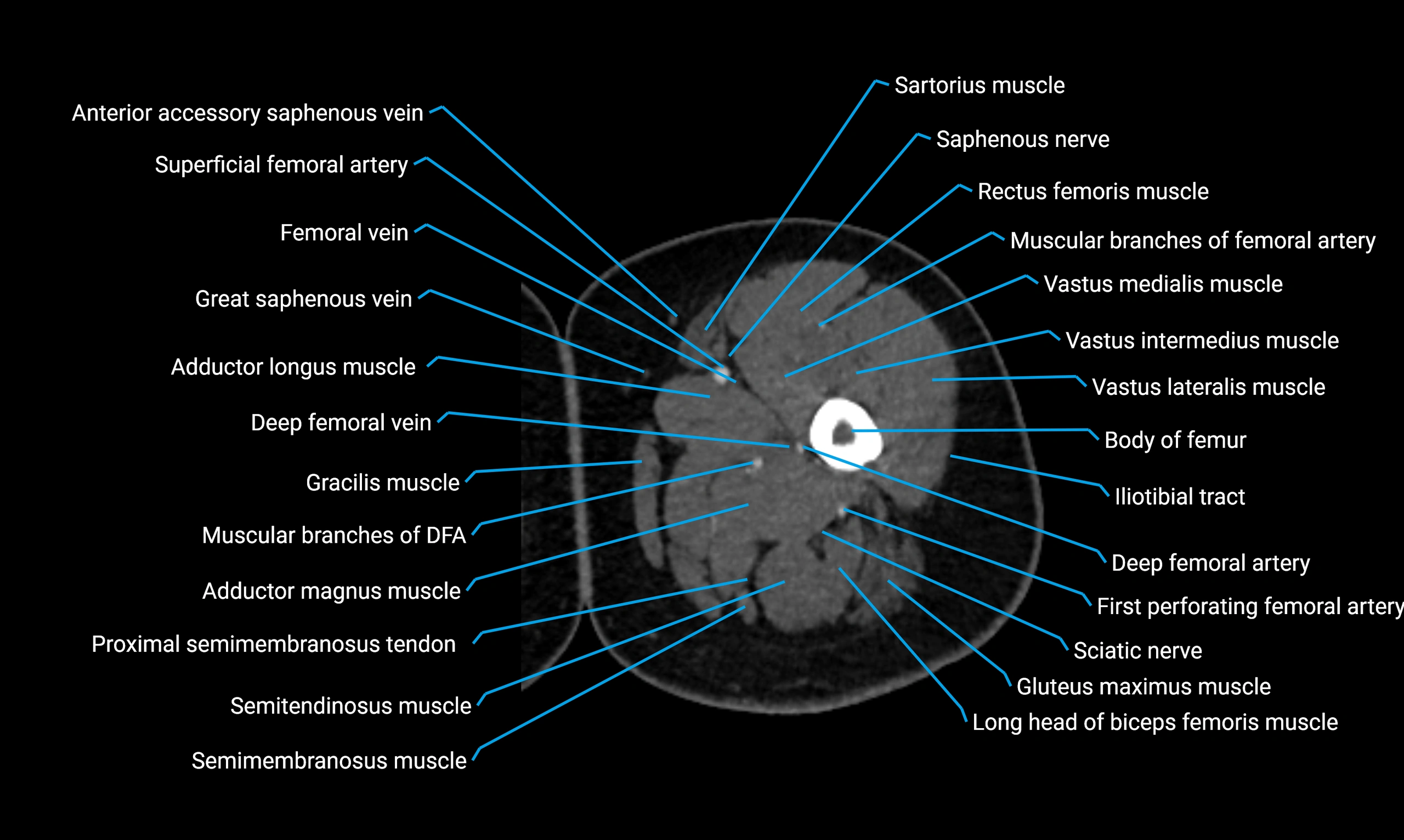 CT lower limb axial cross sectional anatomy labelled image 34 (2).webp